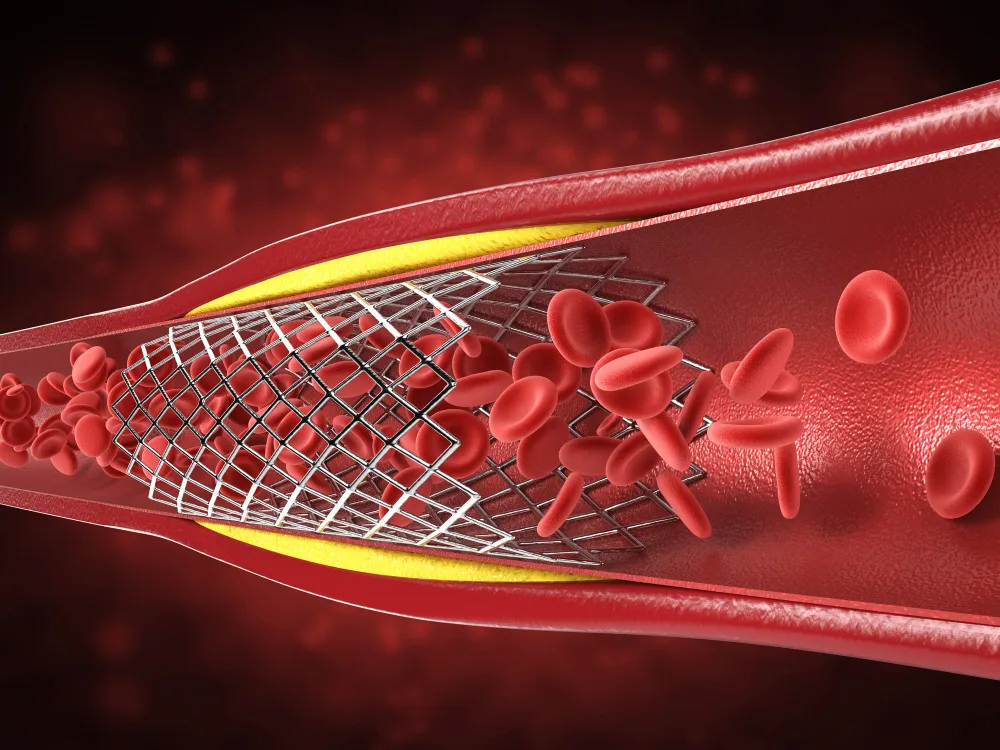Angioplastia y colocación de Stent en Coartación Aórtica en CDMX